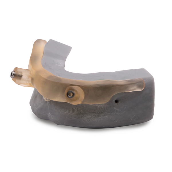 Bone Reduction