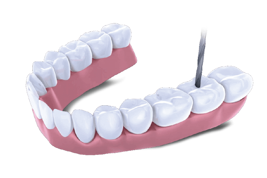 Smart Denture Conversion