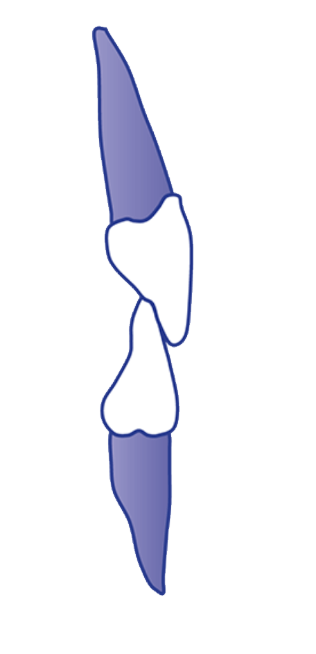 Overbite with Anterior Contact