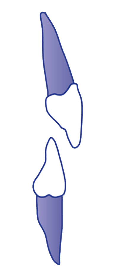 Overbite without Anterior Contact