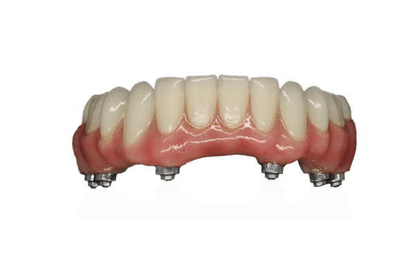 Implant Supported Dentures