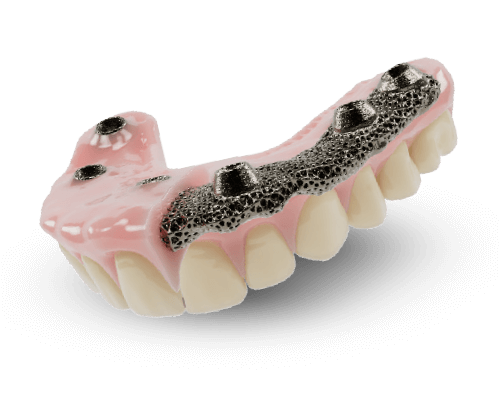 AvaMax full-arch digital hybrid denture with pink acrylic gingiva and high-density acrylic teeth on a titanium bar