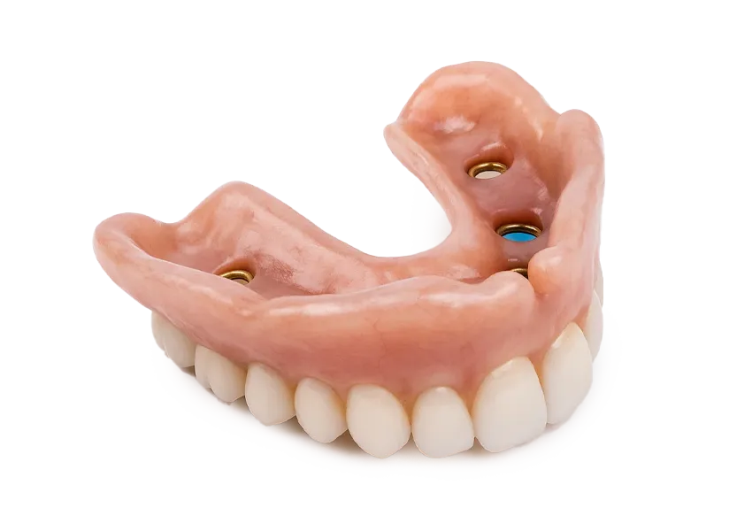 AvaMax Overdenture