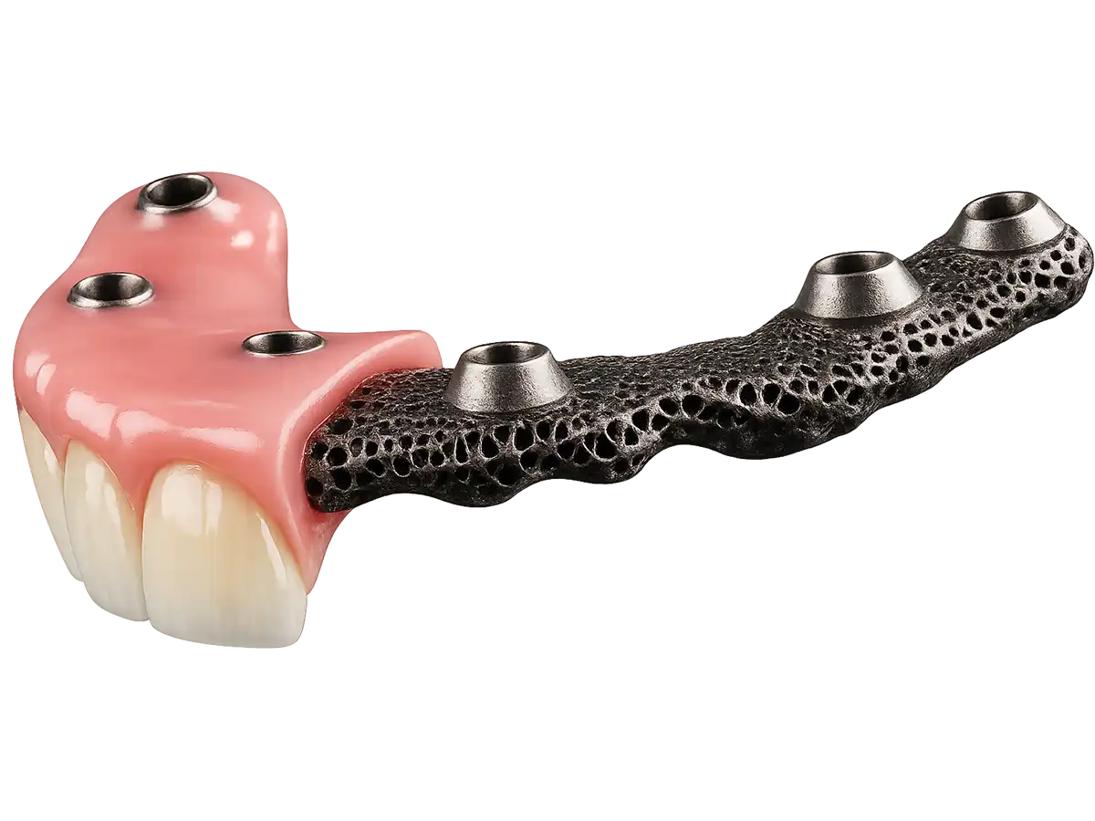 Cutaway of an AvaMax fixed hybrid: PMMA teeth and base over the printed titanium core with screw-access connections