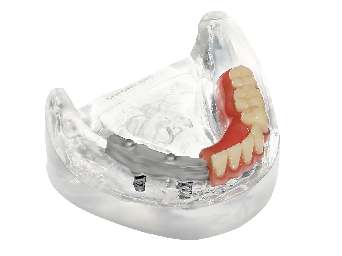 AvaDent Snap-Pin bar denture